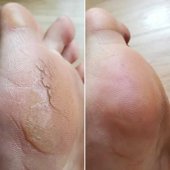 Before and after, Anne D.