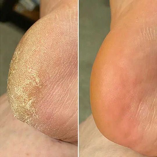 Before and after, Sandra M.